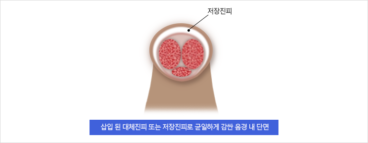 사진3 삽입